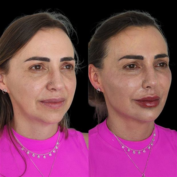 Harmonização full face