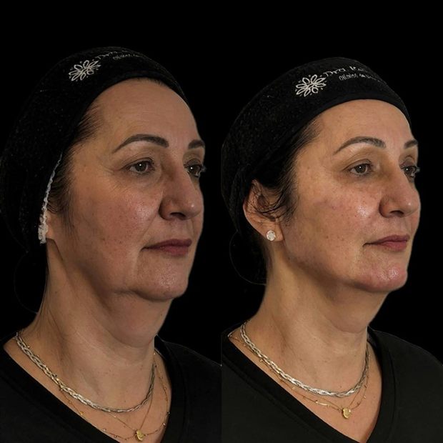 Harmonização full face