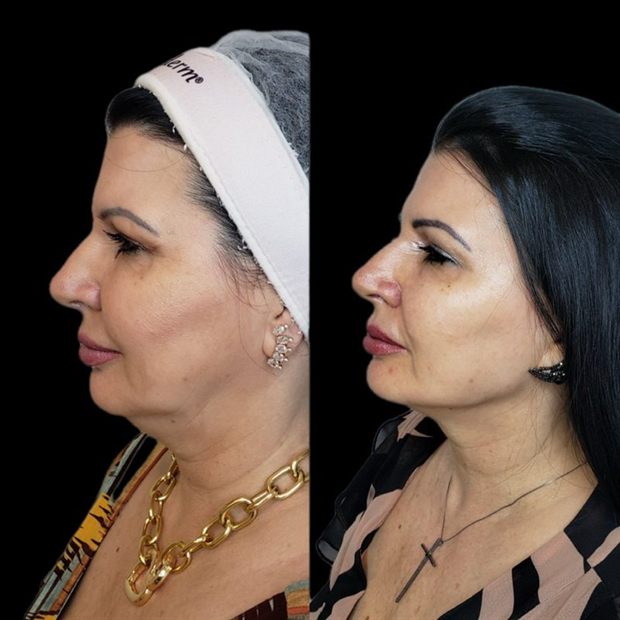 Harmonização full face