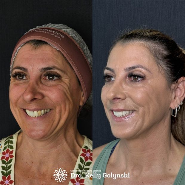 Toxina botulínica