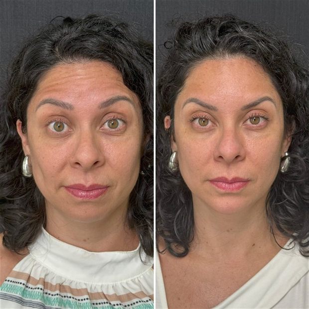 Toxina botulínica