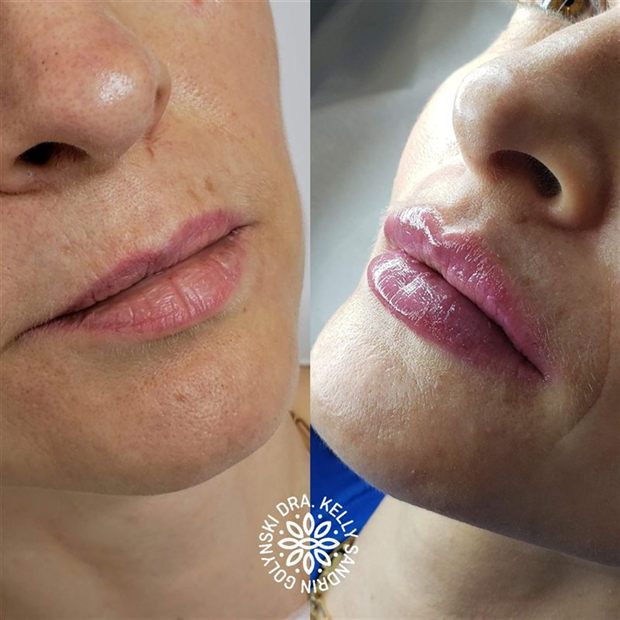Preenchimento labial