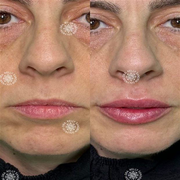 Preenchimento labial